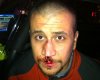 George-Zimmerman-broken-nose.jpg